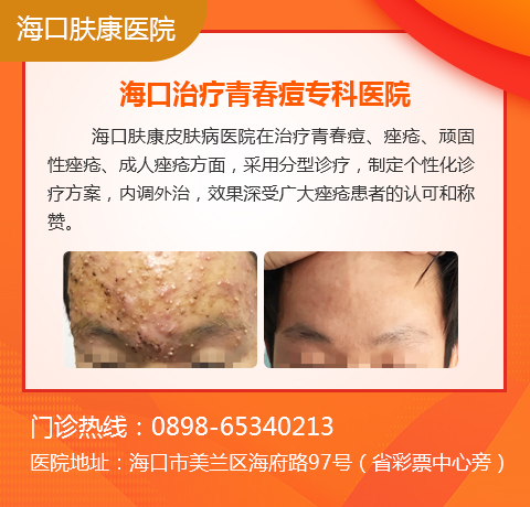 海口中医看痘痘哪里好