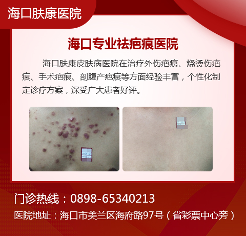 海口看疤痕疙瘩的医院